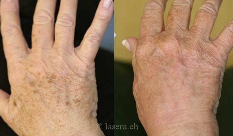 Résultat avant après traitement PhotoGenesis sur les taches brunes des mains