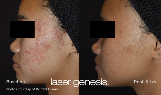 Lasera.ch, photo Laser Genesis cicatrices d'acné 1