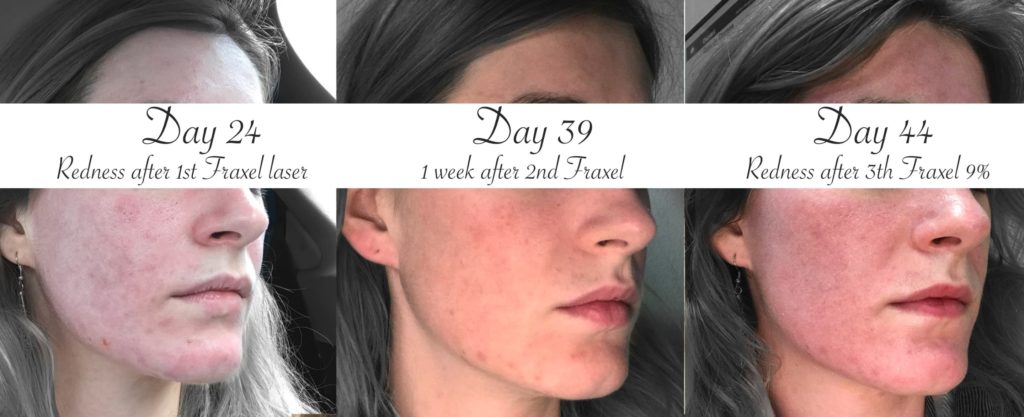 Lasera acne evolution treatment Universkin Laser Genesis KTP Fraxel 24 day to 44 day
