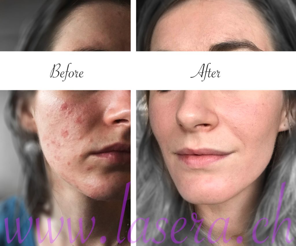 Lasera acne evolution treatment Universkin Laser Genesis KTP Fraxel before and after