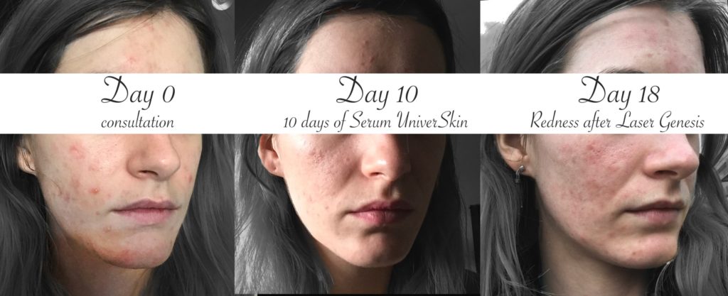 Lasera acne evolution treatment Universkin Laser Genesis KTP Fraxel 0 day to 18 day