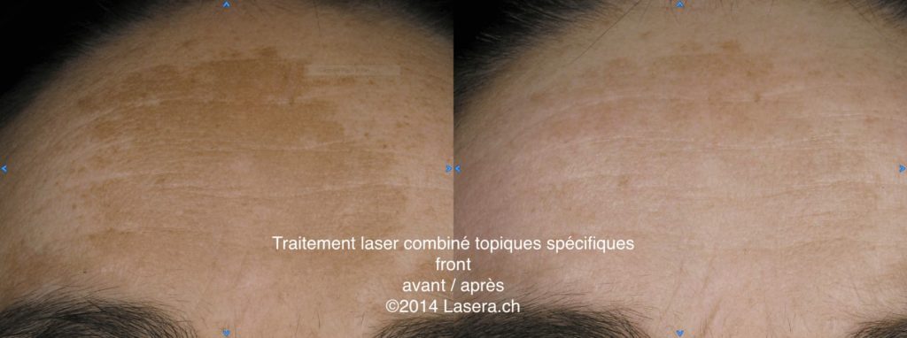 Traitement laser combiné topiques spécifiques - avant / après - front