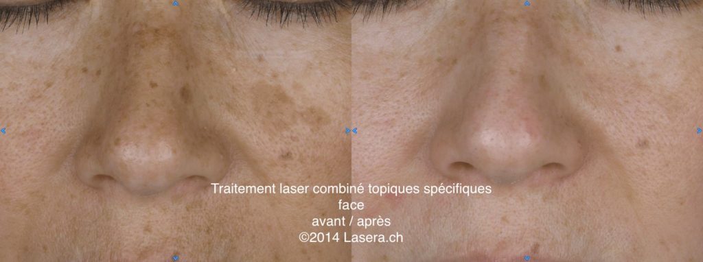Traitement laser combiné topiques spécifiques - avant / après - face