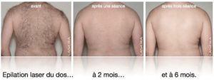 Image avant / après Epilation laser du dos, évolution à 2 et 6 mois, après une et trois séances.