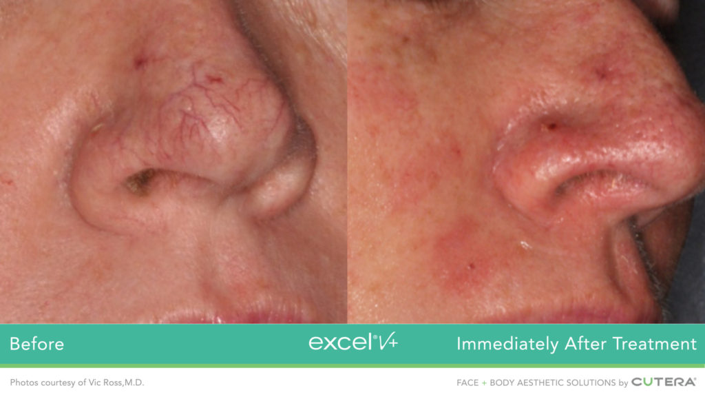 Cutera LaserGenesis Green Genesis Excel V+ Before / After 3 Immediately After Treatment @ 2020 lasera.ch