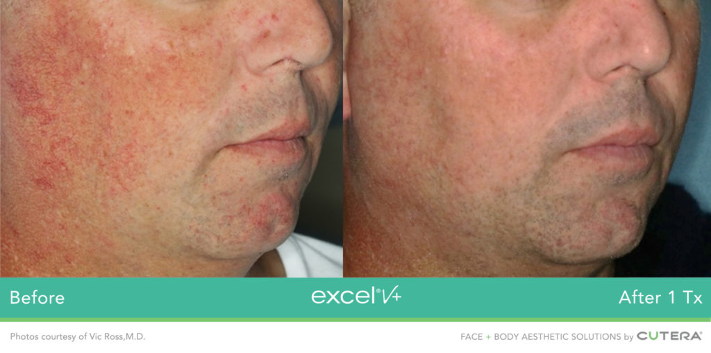 Cutera LaserGenesis, Green Genesis Excel V+ Before / After 1 Txs @ 2020 Lasera.ch