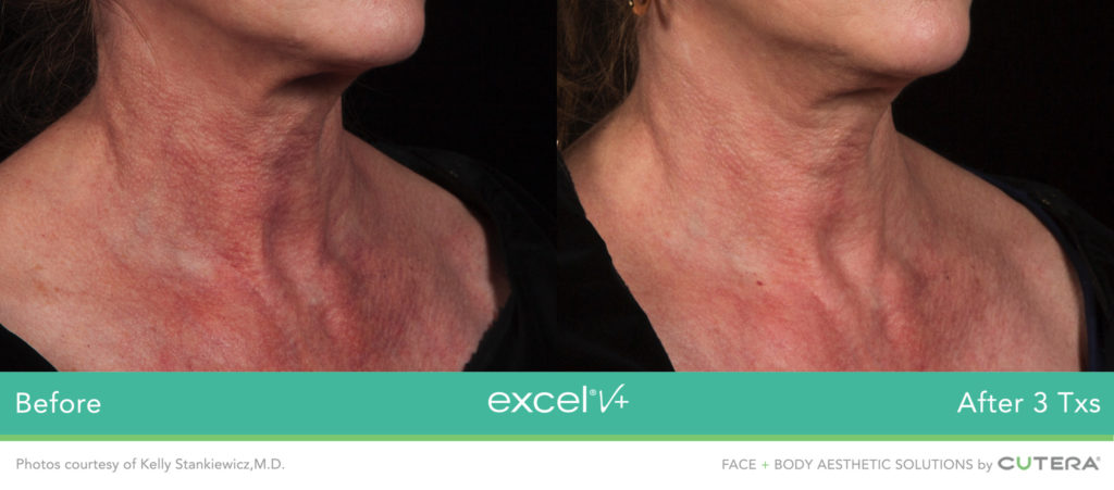 Cutera LaserGenesis, Green Genesis Excel V+ Before / After 3 Txs @ 2020 Lasera.ch