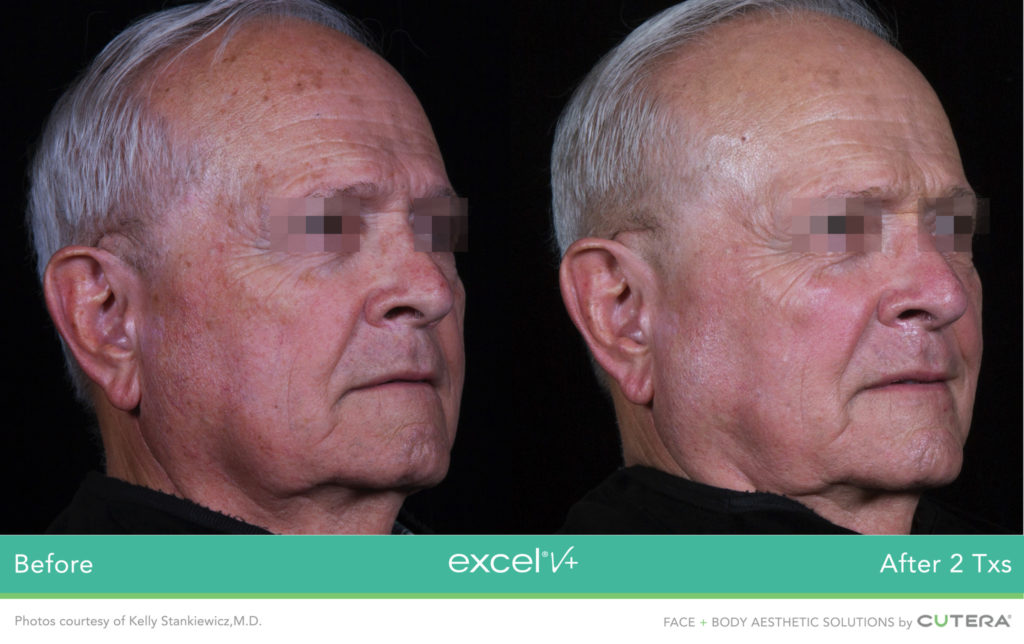 Cutera LaserGenesis, Green Genesis Excel V+ Before / After 2 Txs @ 2020 Lasera.ch