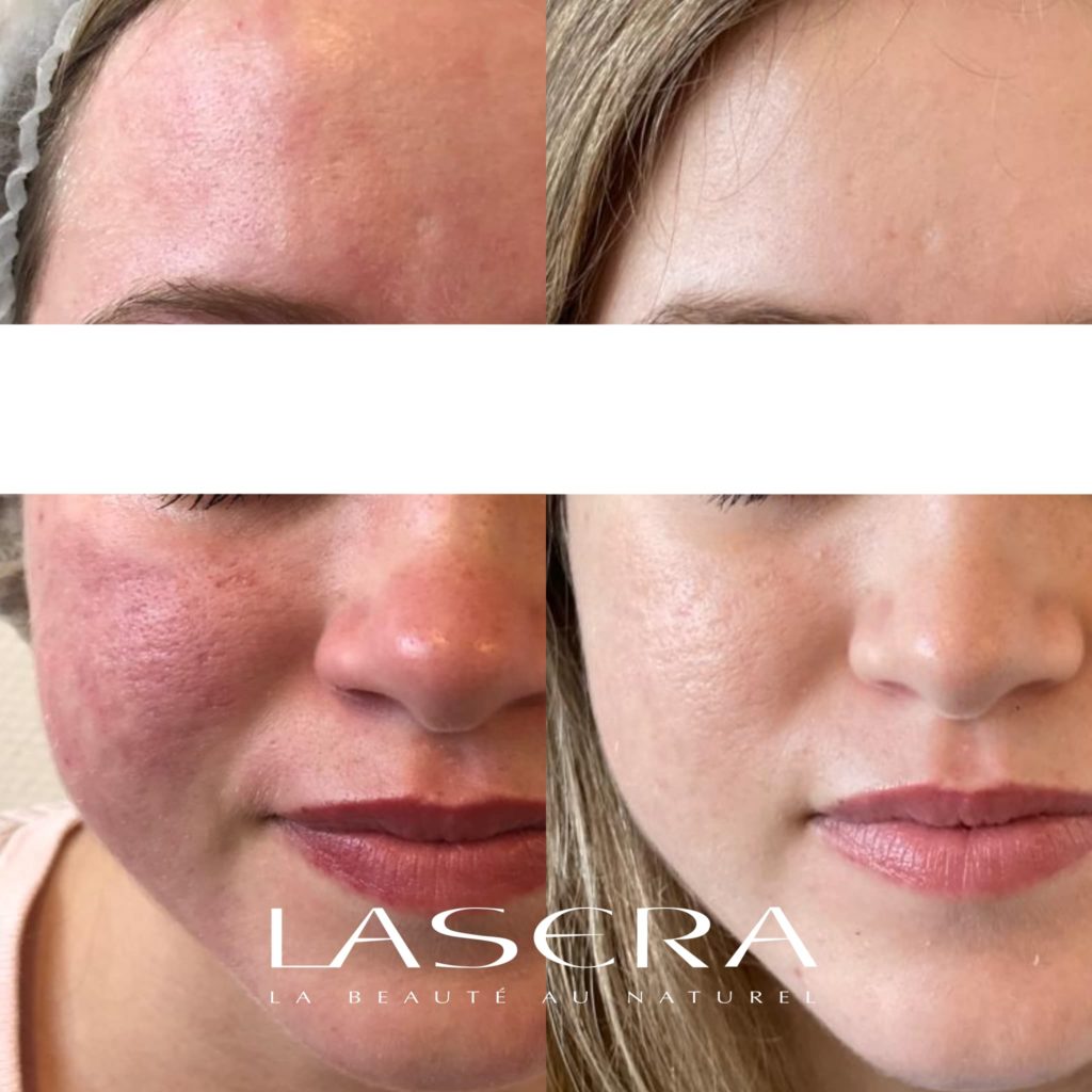 lasera acné avant/apres traitement laserGenesis + Fraxel