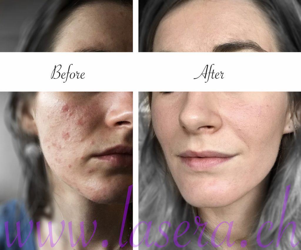 Photo avant après Lasera acne evolution treatment Universkin Laser Genesis KTP Fraxel before and after