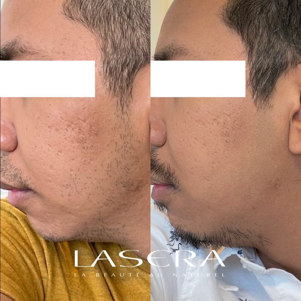 Lasera.ch - face gauche Avant Apres acne Enerjet avec HA Hyaluronique acide deux mois