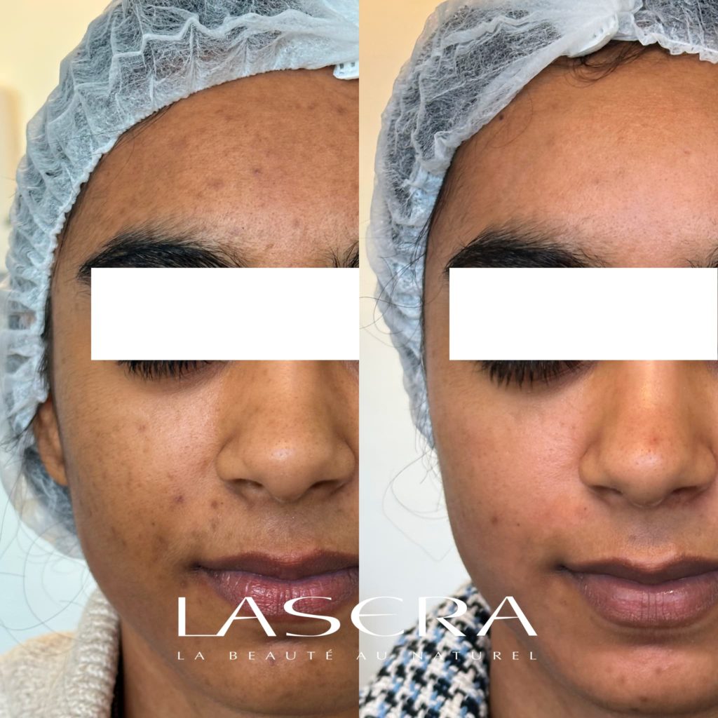 Lasera.ch - Face Avant Apres - Traitement combine Lasers 532nm et LaserGenesis de ExcexlV Plus et Fraxel Dual peau foncée mai 2023
