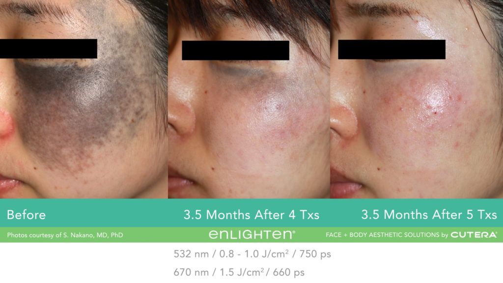 Avant après d'un traitement des taches pigmentaires et détatouage au laser Enlighten Cutera sur le visage.