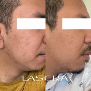 Lasera.ch - Face Droite Avant Apres acne Enerjet avec HA Hyaluronique acide deux mois