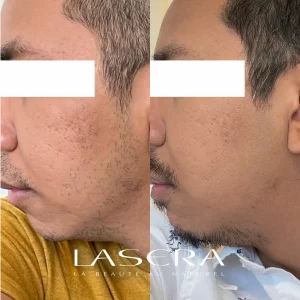 Lasera.ch - Face Droite Avant Apres acne Enerjet avec HA Hyaluronique acide deux mois